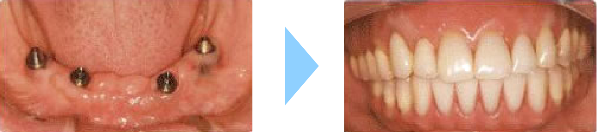 オールオンフォー治療