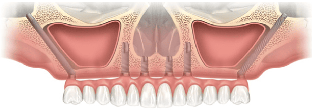 ザイゴマインプラント