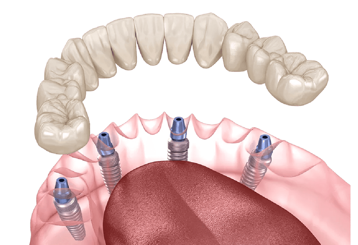 オールオンフォー治療