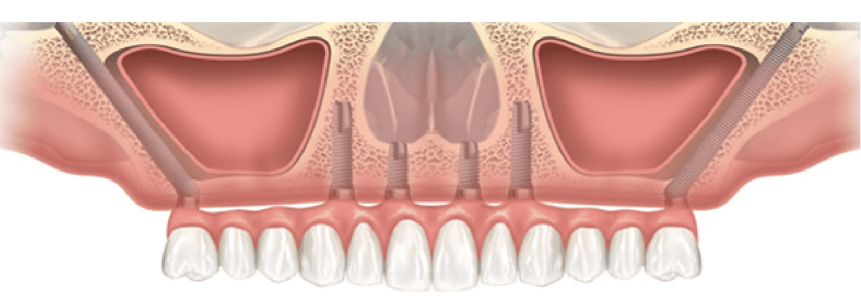ザイゴマインプラント