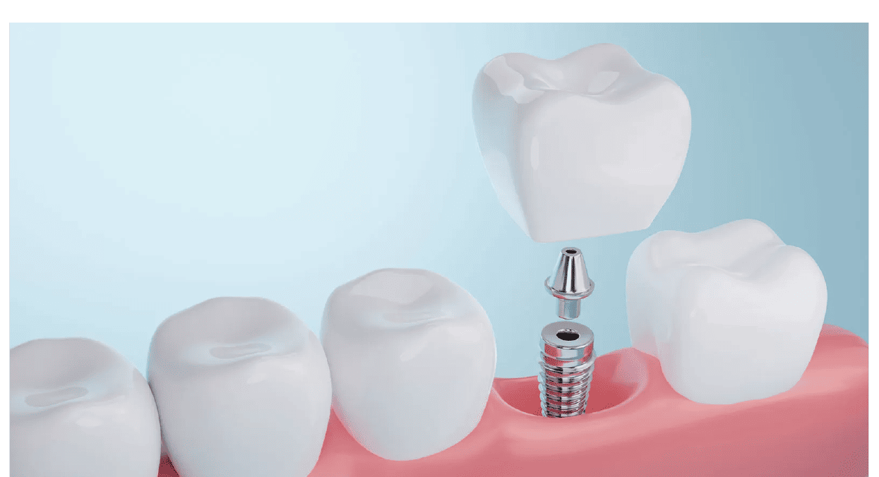 1本からできるインプラント治療